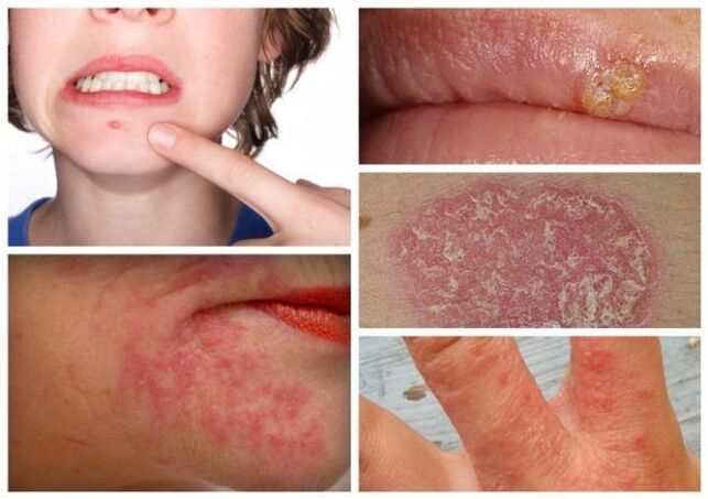 Alergie a kožné ochorenia sú príznakmi parazitov v tele