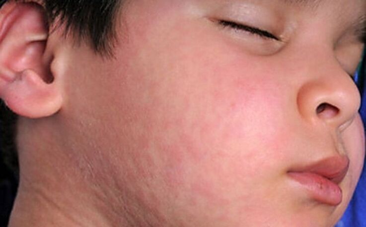 Alergické vyrážky na koži - príznak prítomnosti parazitických červov v tele